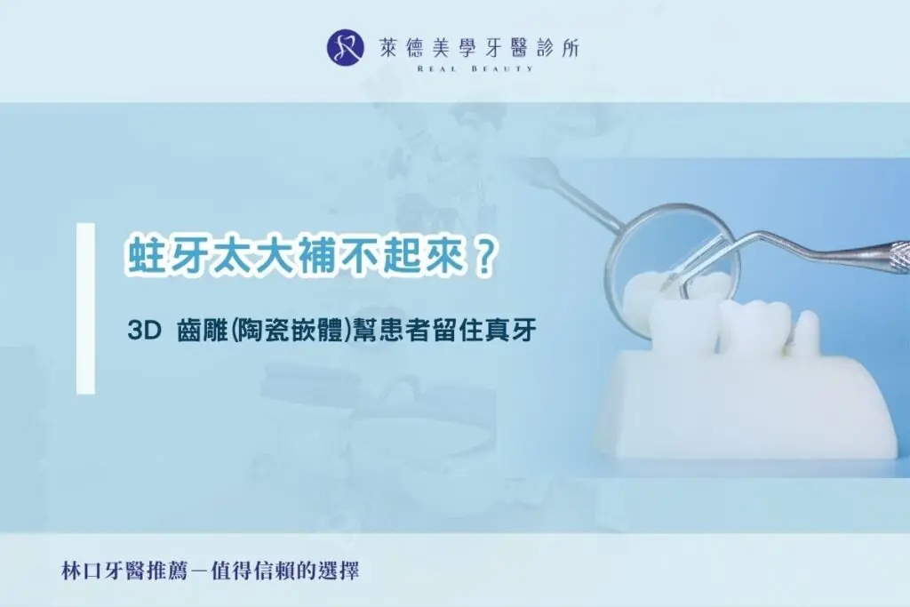 蛀牙太大補不起來？3D 齒雕(陶瓷嵌體)幫患者留住真牙