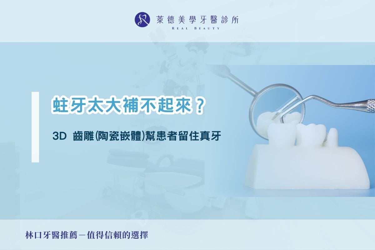 蛀牙太大補不起來？3D 齒雕(陶瓷嵌體)幫患者留住真牙