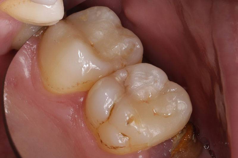 3D齒雕案例 01治療後