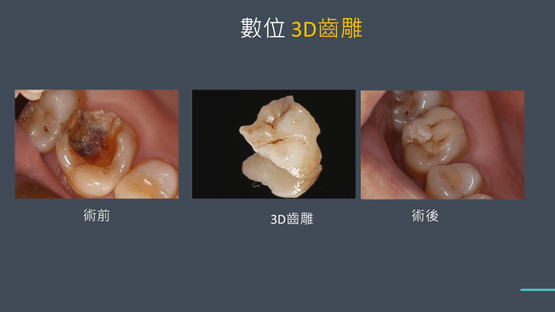 3D齒雕價格解析,3D齒雕缺點是甚麼 1 3D齒雕案例
