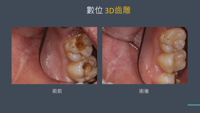 陶瓷嵌體ptt討論度高,你需要知道的陶瓷嵌體缺點 3 3D齒雕案例2