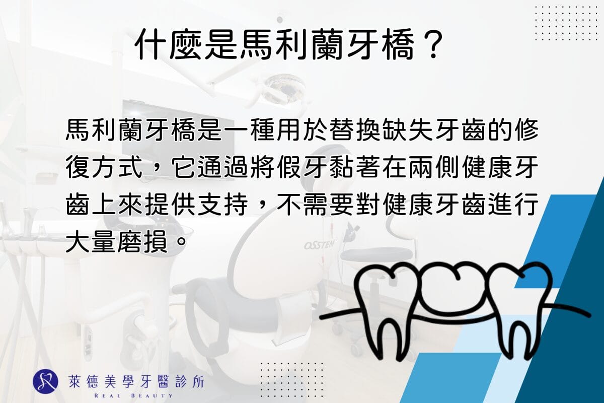 什麼是馬利蘭牙橋？黏著式牙橋