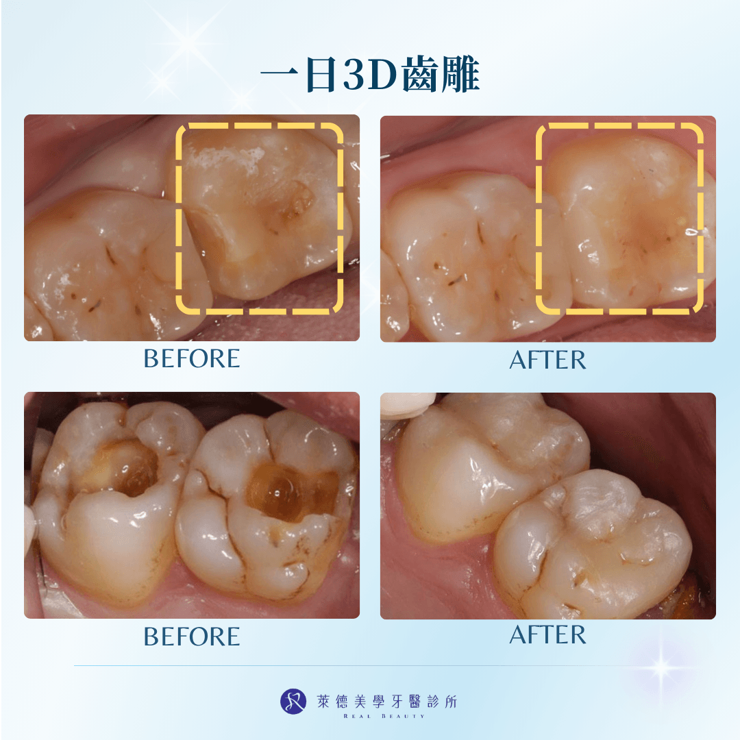 3D齒雕照片