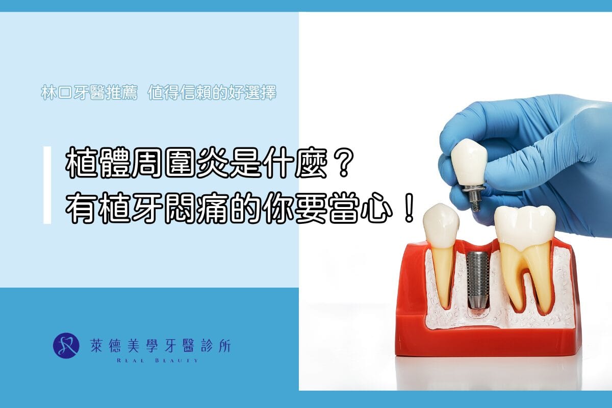 植體周圍炎是什麼?有植牙悶痛的你要當心!