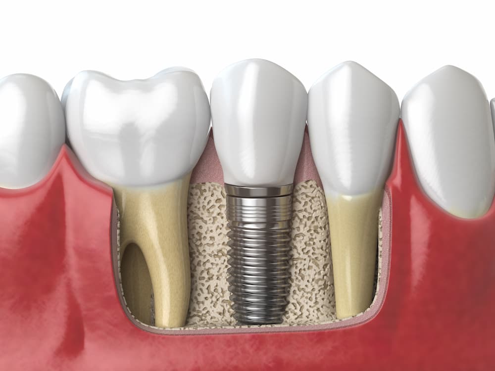 implants