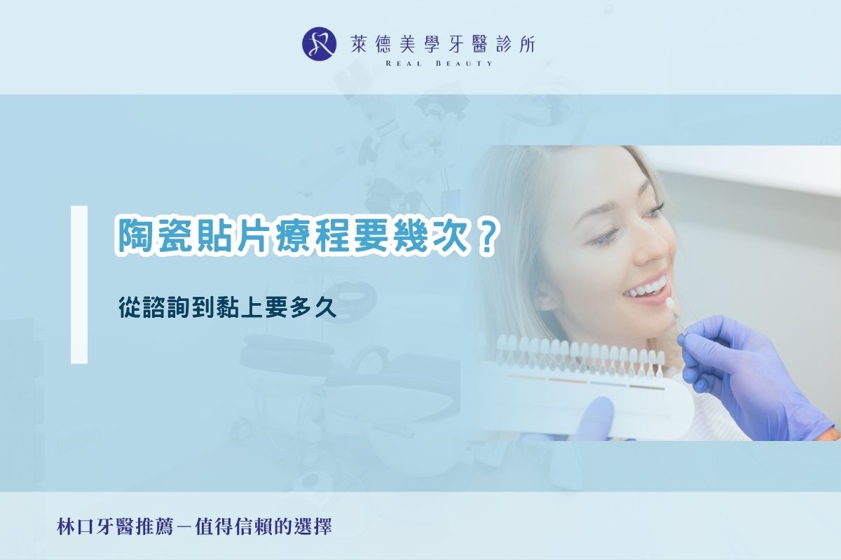 陶瓷貼片療程要幾次?從諮詢到黏上要多久