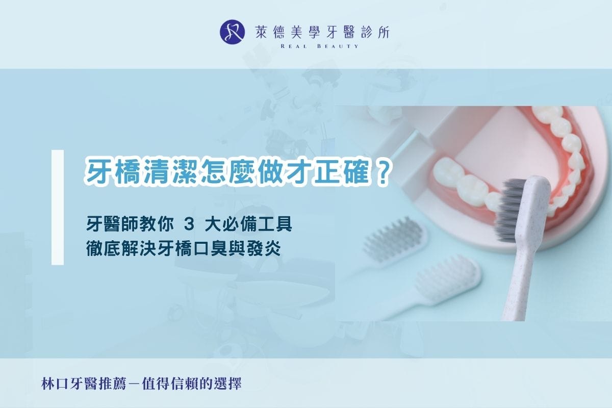 牙橋清潔怎麼做才正確?牙醫師教你 3 大必備工具,徹底解決牙橋口臭與發炎