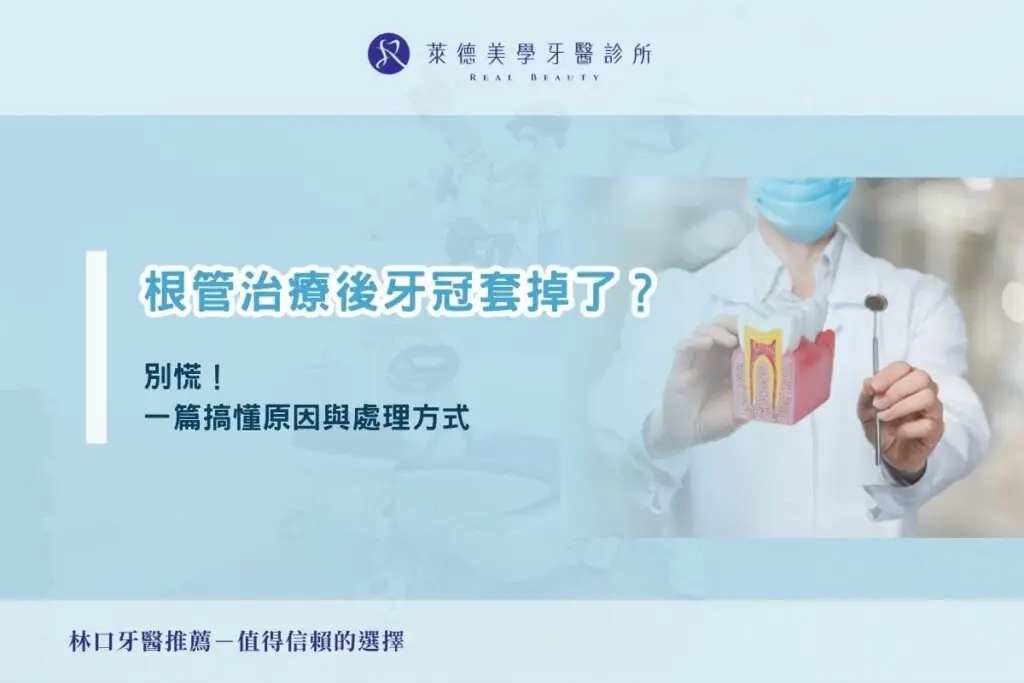 根管治療後牙冠套掉了？別慌！一篇搞懂原因與處理方式