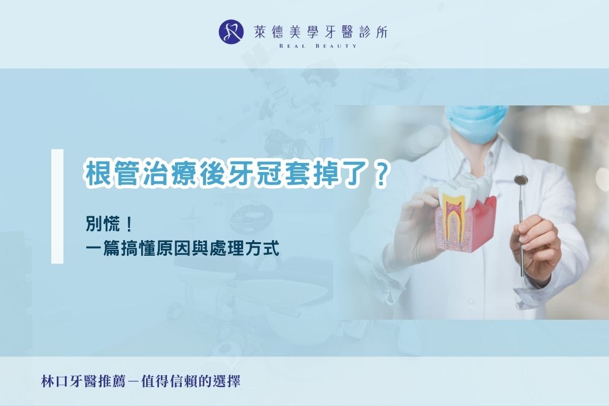 根管治療後牙冠套掉了?別慌!一篇搞懂原因與處理方式