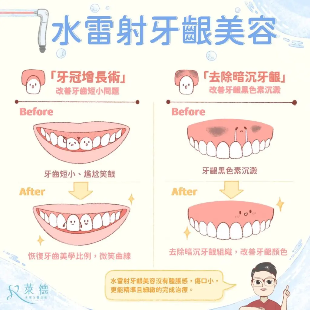 水雷射牙齦