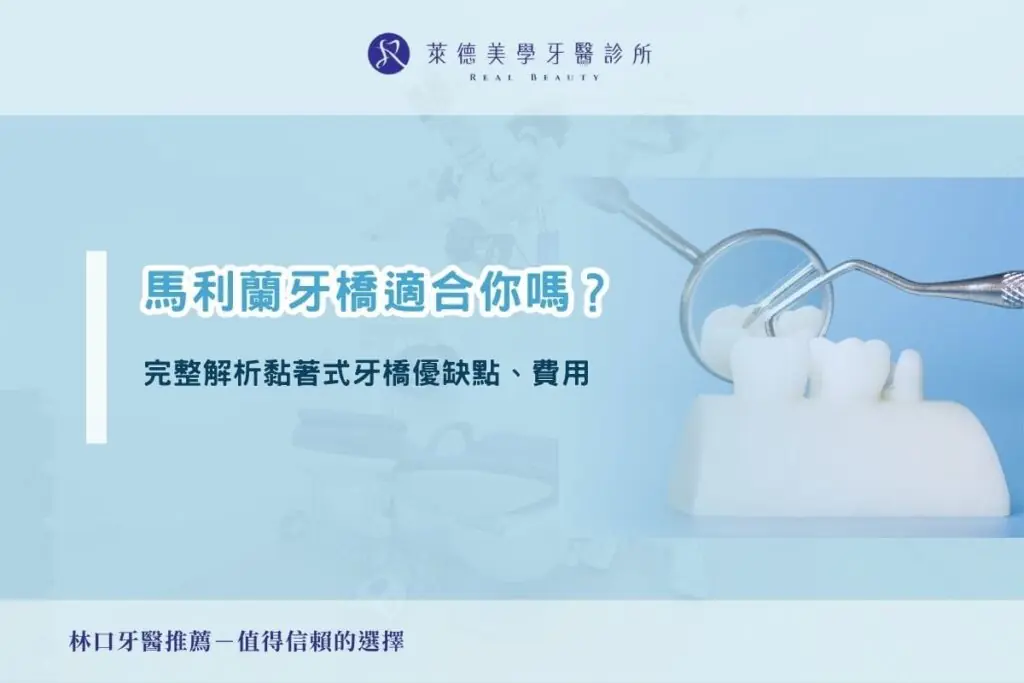 馬利蘭牙橋適合你嗎？完整解析黏著式牙橋優缺點、費用