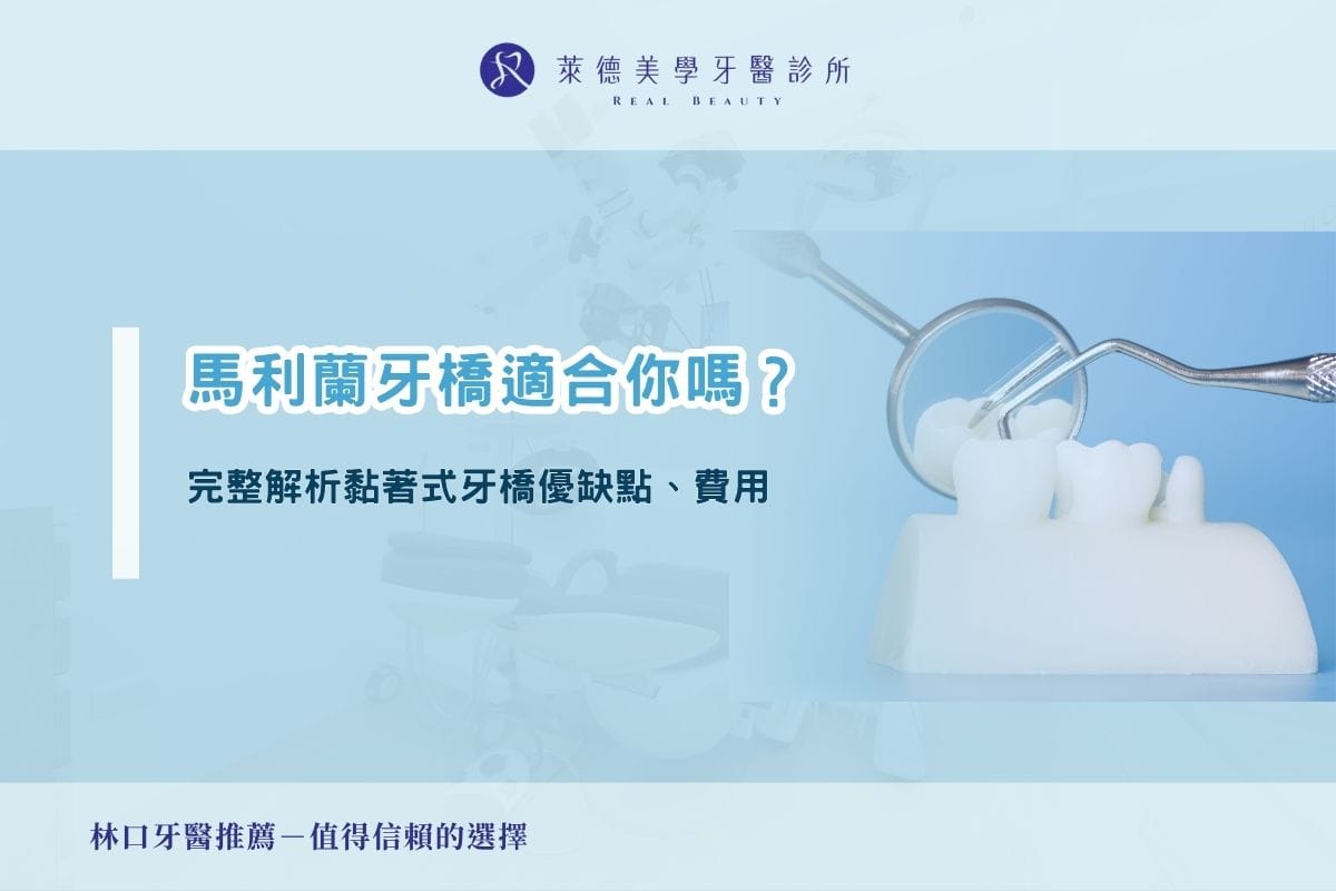 馬利蘭牙橋適合你嗎?完整解析黏著式牙橋優缺點、費用