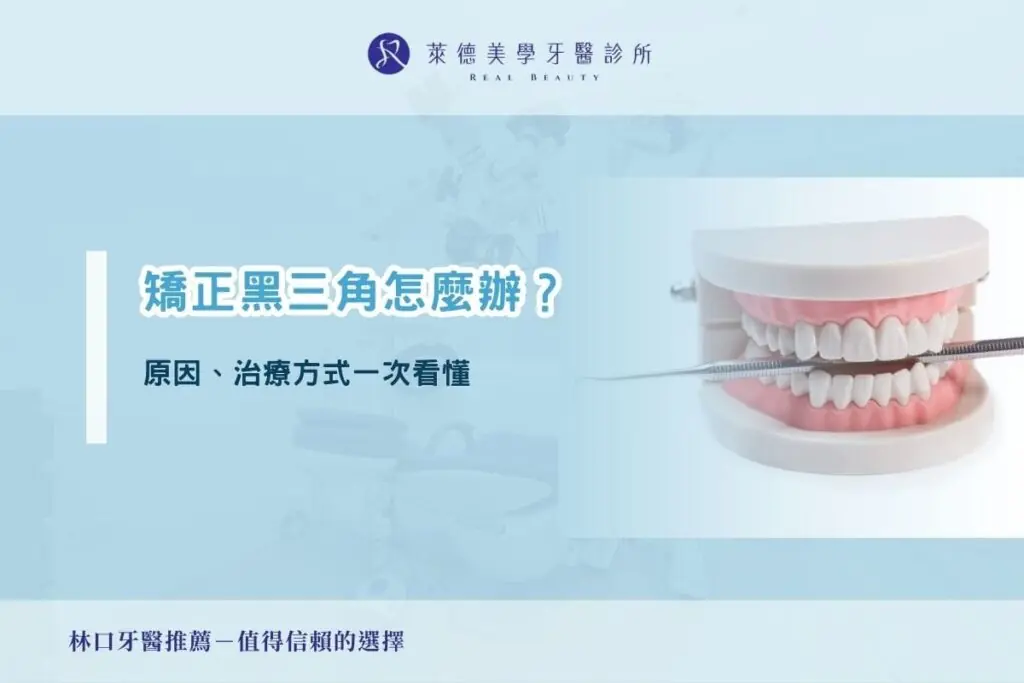 矯正黑三角怎麼辦？原因、治療方式一次看懂