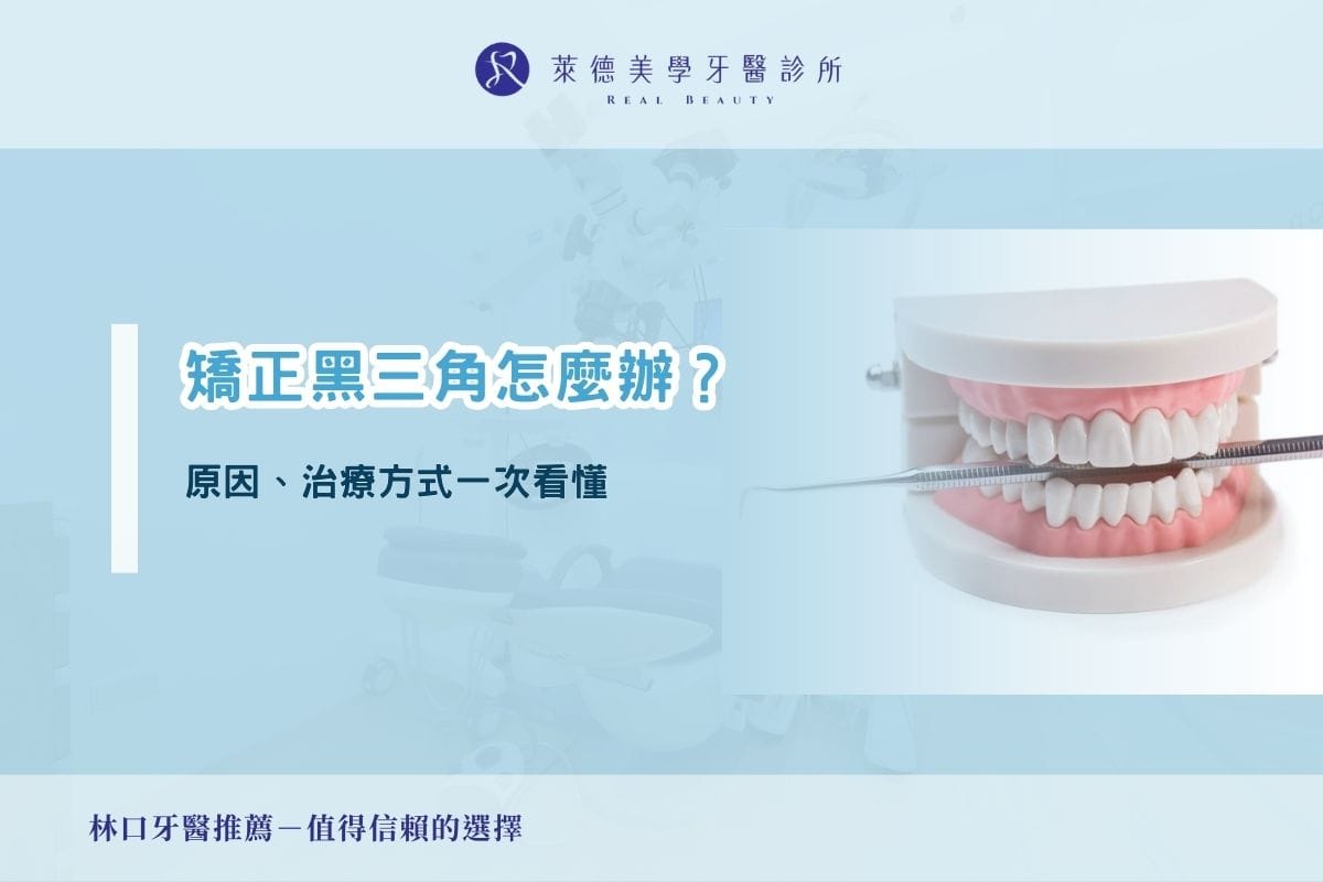 矯正黑三角怎麼辦?原因、治療方式一次看懂