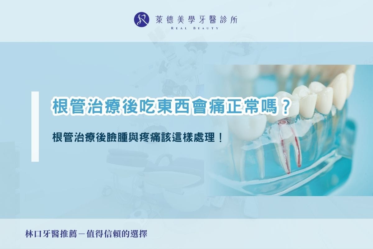 根管治療後吃東西會痛正常嗎?當心根管治療後臉腫與疼痛該這樣處理!