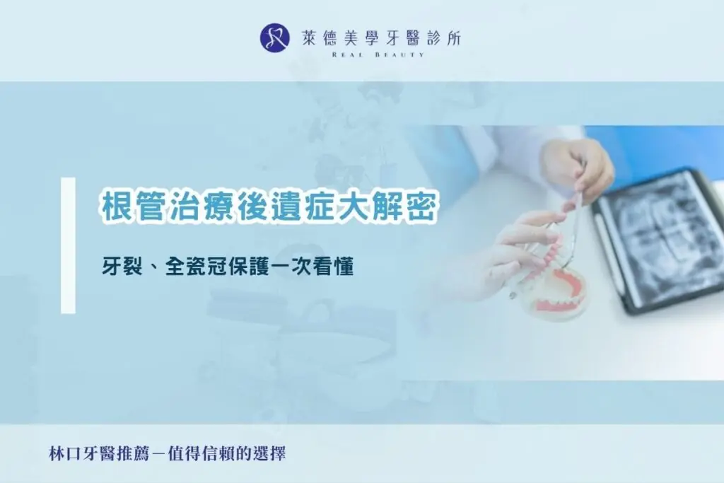 根管治療後遺症大解密｜牙裂、全瓷冠保護一次看懂