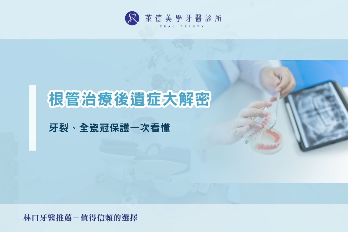 根管治療後遺症大解密|牙裂、全瓷冠保護一次看懂