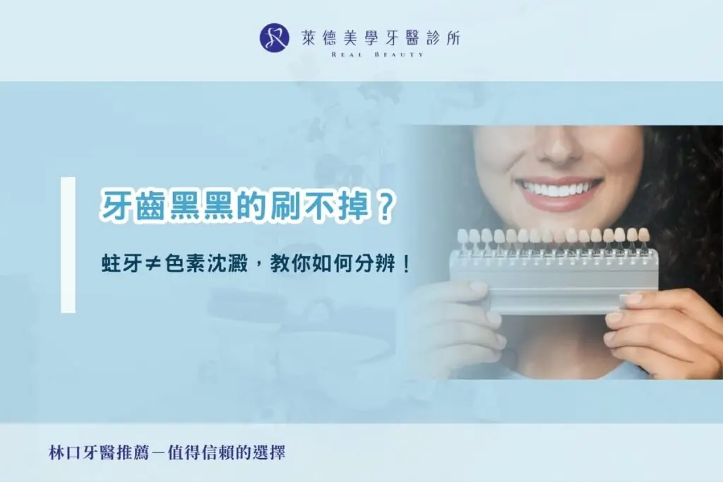 牙齒黑黑的刷不掉？蛀牙不等於色素沈澱，教你如何分辨！
