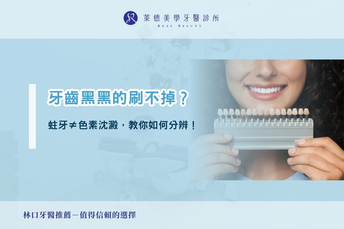 牙齒黑黑的刷不掉?蛀牙不等於色素沈澱,教你如何分辨!