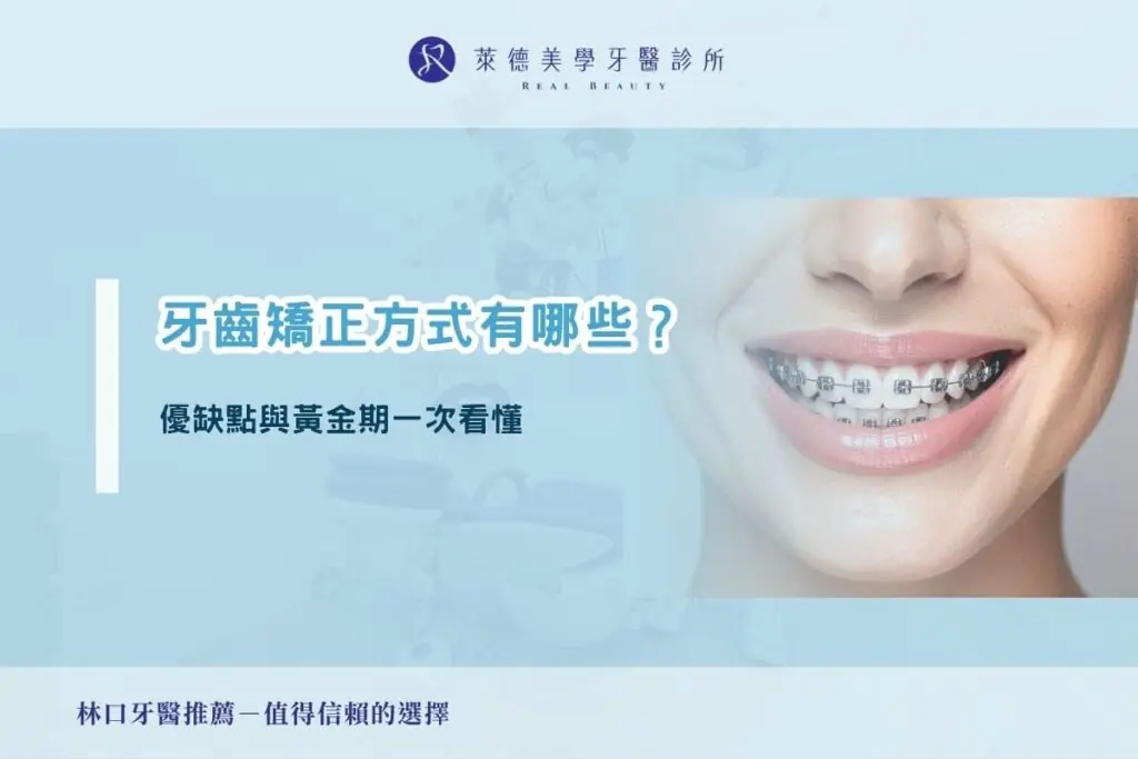 牙齒矯正方式有哪些？優缺點與黃金期一次看懂