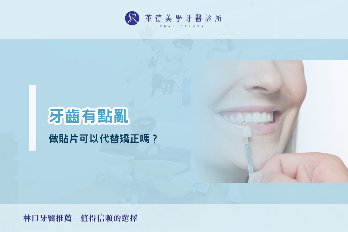 牙齒有點亂,做貼片可以代替矯正嗎?