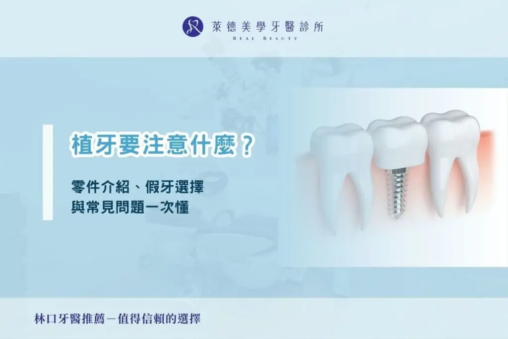 植牙要注意什麼？零件介紹、假牙選擇與常見問題一次懂