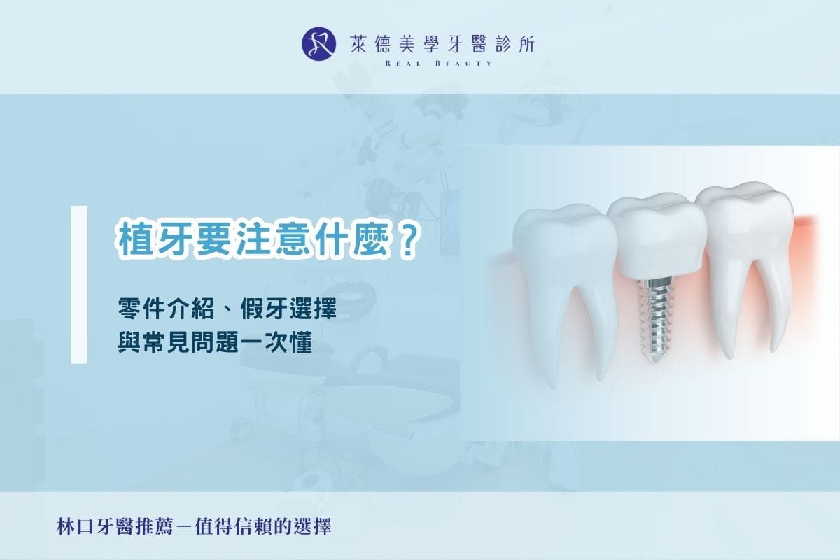 植牙要注意什麼？零件介紹、假牙選擇與常見問題一次懂