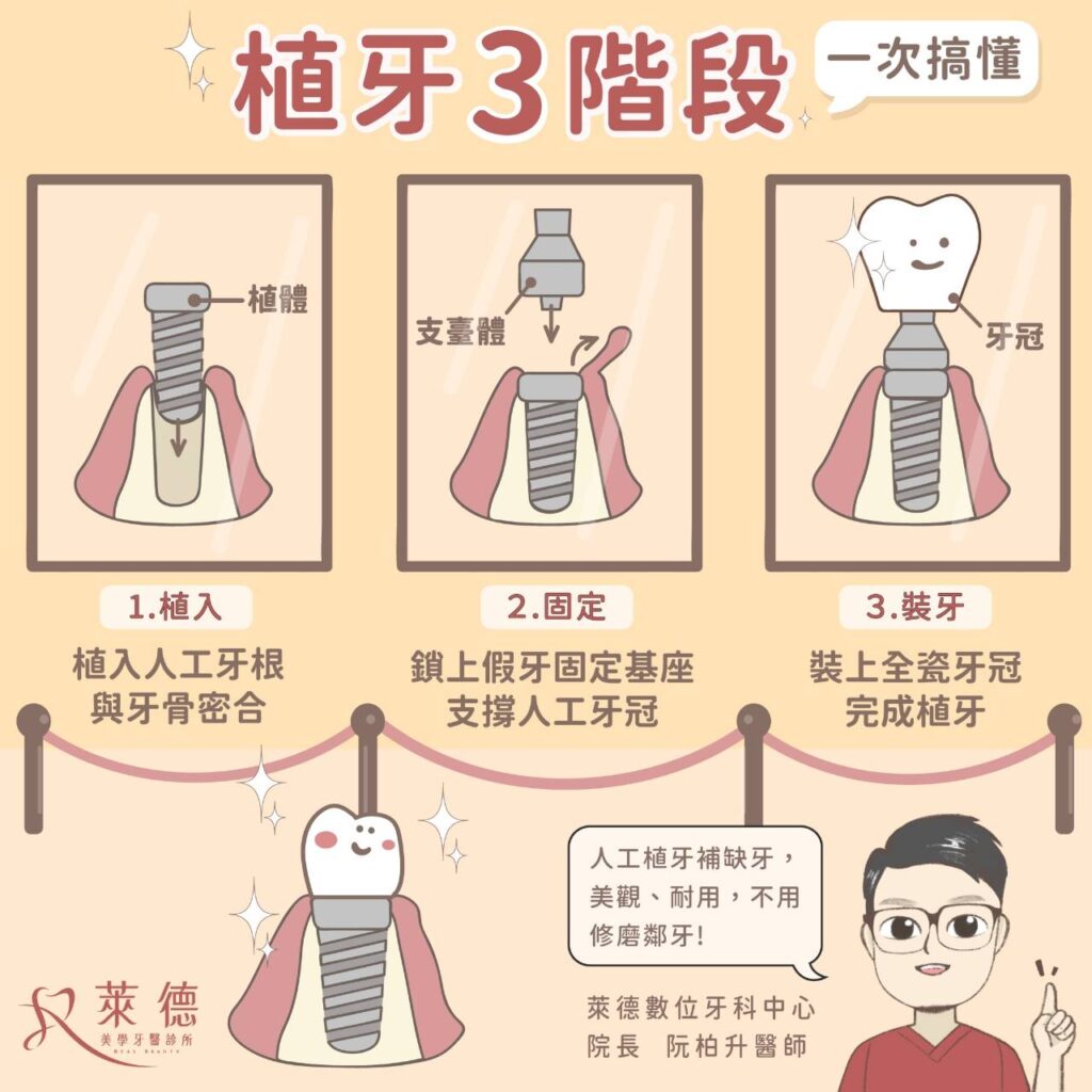 林口牙醫推薦 萊德牙醫 植牙推薦 植牙流程 1